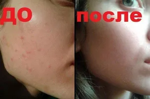 Отзиви - intraskin - Spot крем за акне