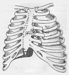 Rib simptome fracturi, cauze, complicații