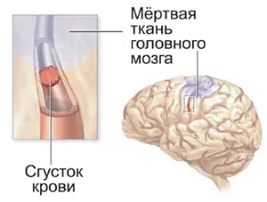 Primele semne si simptome de accident vascular cerebral si atac de cord la barbati si femei