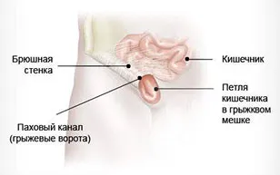 preturi hernie inghinală, o intervenție chirurgicală pentru a elimina o hernie, tratamentul chirurgical al herniei inghinala