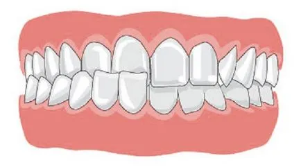 Kereszt harapás - az okok, következmények és módszerek ustraneniya- Fogászati ​​portál