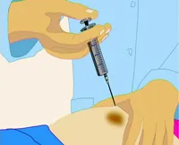 Hogyan kerüljük el a szövődmények inetsy - mik a szövődmények az injekció beadása után - egy injekciós bump zúzódás