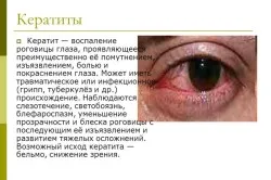 Как за лечение на сухо око