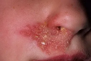 Hogyan kell kezelni a herpesz az arcon