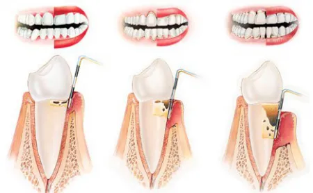 Hogyan kell kezelni a periodontális betegség tüneteit és a betegségek megelőzése