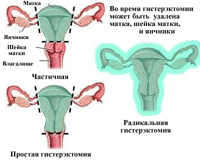 Consecințele îndepărtarea uterului pentru femei