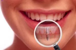 Cauzele hemoragiilor după implanturi dentare