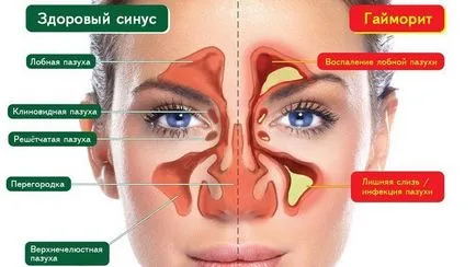 Причини за синузит при възрастни психосоматични