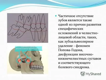 Представяне на ортопедично лечение на частично отсъствие на зъби гума и