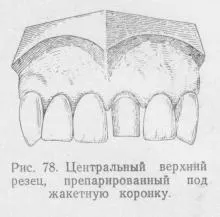 Протезиране пластмасови корони, протезен стоматология