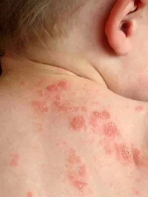 Psihosomatica eczema la copii fotografie, cauzele psihologice ale eczeme la nivelul mâinilor și picioarelor copilului