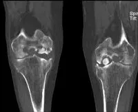 osteocondrita disecanta - cauze, simptome, diagnostic și tratament