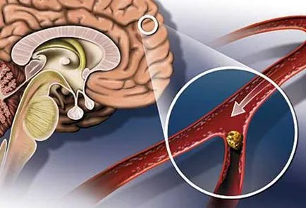 Reabilitarea dupa un atac de cord, consecințele vostanovlenie, accident vascular cerebral