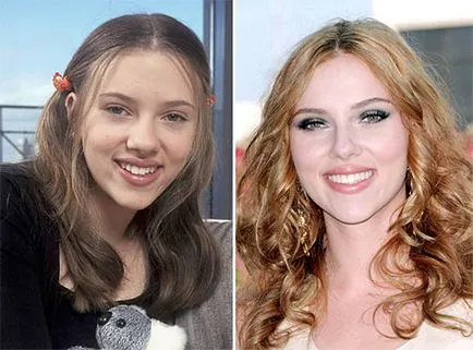 Ринопластика снимки на известни личности преди и след операция