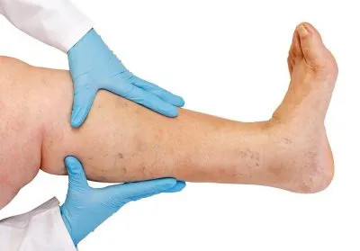 Tünetek, mint thrombophlebitis, jelek és okai