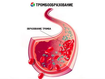 Tünetek, mint thrombophlebitis, jelek és okai