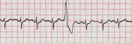 Sinus arrhythmia okozza, tünetei és kezelési módszerek