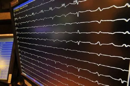 Sinus arrhythmia okozza, tünetei és kezelési módszerek