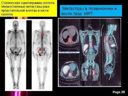 Cât de mulți trăiesc cu tiroidian răspuns cancer oncolog