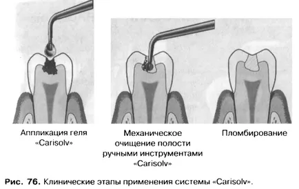 Методите и принципите на получаване на кухини - добра дентална портал, добри