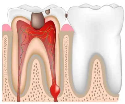 Зъб екстракция цена отстраняване и лечение на зъбния киста киста