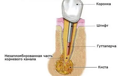 îndepărtarea chistului dinte prețul de extracție și tratamentul chist dentar