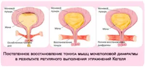 Упражнения за укрепване на пикочния мехур при мъжете и жените