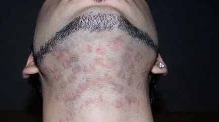 Szörnyű sérülést és pigmentáció szövődményeként lézeres szőrtelenítés, szőrös kérdés