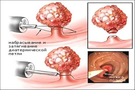 Tipuri de tratament chirurgical de polipi nazali