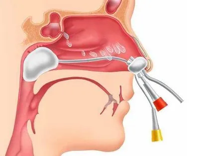 Tipuri de tratament chirurgical de polipi nazali