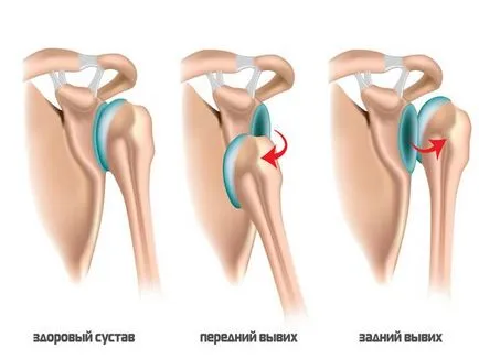 umăr tratament dislocat după reducere