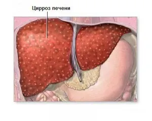 Hogyan lehet megállítani cirrhosis előrejelzések élet