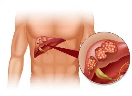 Hogyan lehet megállítani cirrhosis előrejelzések élet