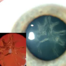 Posterior cauze cataractă subcapsulară și tratament