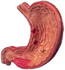 ulcer gastric - boala, tratament, dieta, cauze, simptome