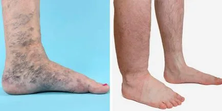 Indított visszerek a lábon tünetek, fotó, kezelés