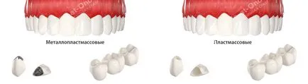 Coroanele dentare pe tipuri de implanturi și prețuri