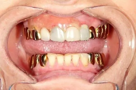 Dental злато проба и прилагане