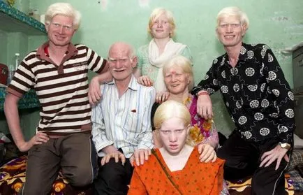 25 любопитни и удивителни факти за албиноси хора