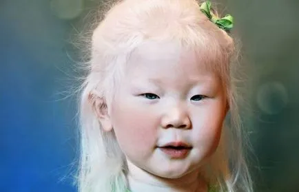 25 любопитни и удивителни факти за албиноси хора
