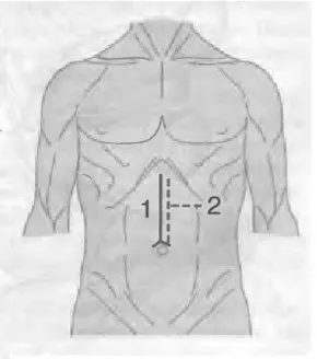 prejudiciu abdominale