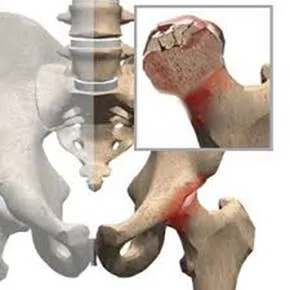 Алтернатива (нехирургично) третиране на некроза на феморалната глава конвенционална лекарствена