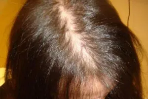 Alopecia (kopaszság) nőknél típusok, okok, kezelés