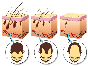 Alopecia, hogy az, amit azok a típusok, és hogyan kell kezelni őket