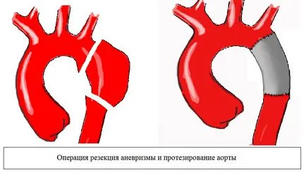 Anevrism al aortei toracice