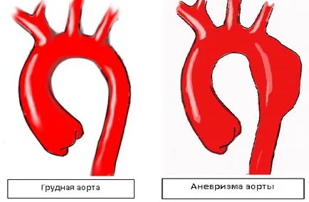 Aneurysm a mellkasi aorta