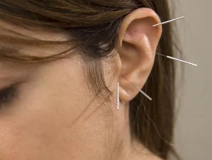 puncte de acupunctura pe urechi