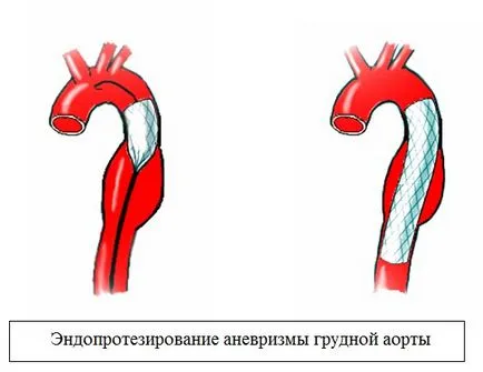 Aneurysm a mellkasi aorta