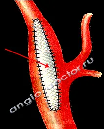 carotis atherosclerosis