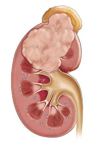 Apostematozny pielonefrita cauze, simptome, diagnostic, tratament